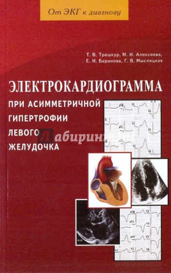 Электрокардиограмма при асимметричной гипертрофии левого желудочка