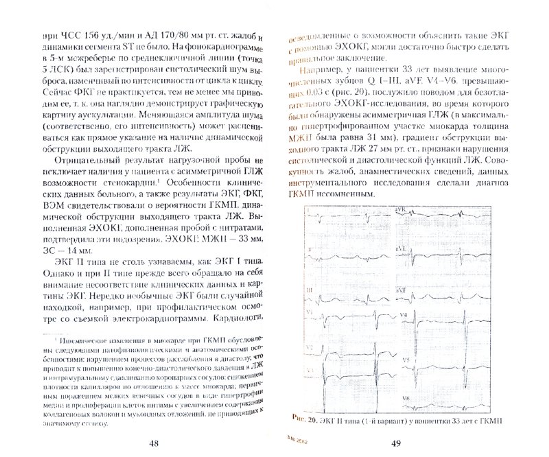 Иллюстрация 1 из 4 для Электрокардиограмма при асимметричной гипертрофии левого желудочка - Трешкур, Баранова, Алексеева, Мыслицкая | Лабиринт - книги. Источник: Лабиринт
