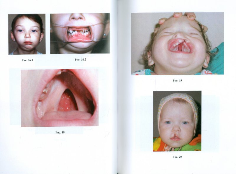 Иллюстрация 1 из 13 для Детская челюстно-лицевая хирургия. Сборник иллюстрированных клинических задач и тестов - Топольницкий, Гургенадзе, Гальперина | Лабиринт - книги. Источник: Лабиринт