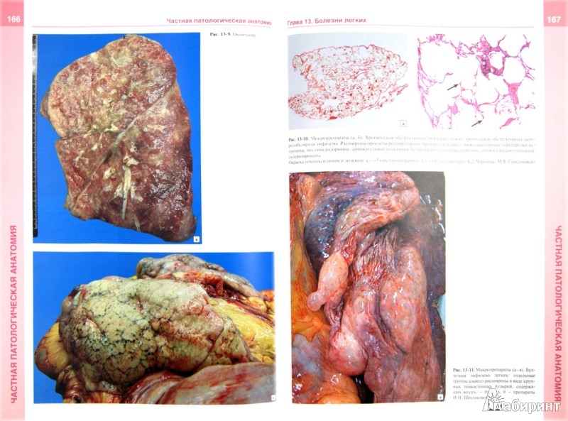 Атлас По Патологической Анатомии