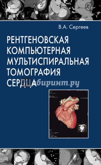 Рентгеновская компьютерная мультиспиральная томография сердца