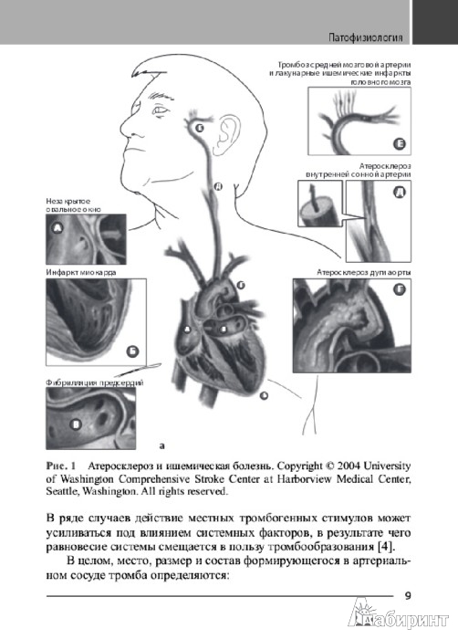 Иллюстрация 1 из 10 для Антитромботическая терапия в профилактике ишемического инсульта - Беккер, Спенсер | Лабиринт - книги. Источник: Лабиринт