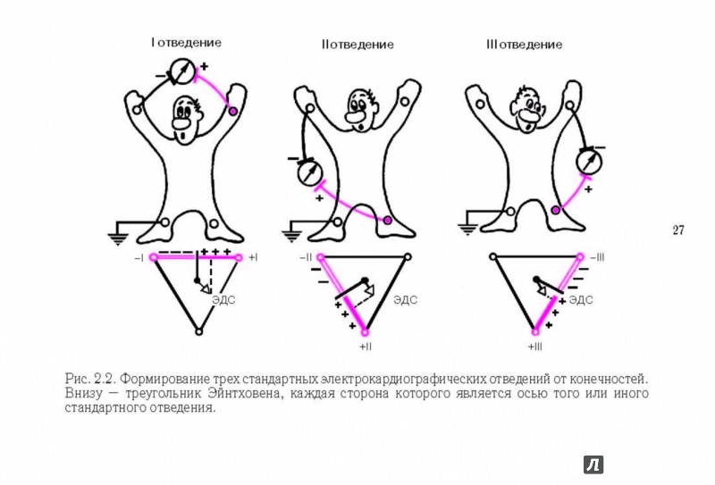 Низкоамплитудные отведения экг