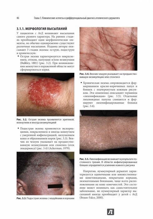 Атопический дерматит и экзематозные расстройства | Книжный Лабиринт