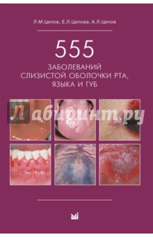 555 заболеваний слизистой оболочки рта, языка и губ - Цепов, Цепова, Цепов