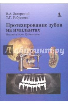 Протезирование зубов на имплантатах - Загорский, Робустова