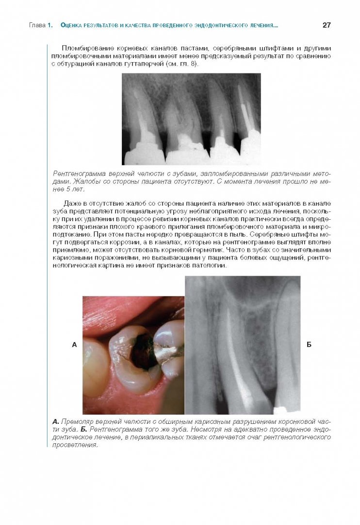 Иллюстрация 17 из 26 для Решение проблем в эндодонтии. Профилактика, диагностика и лечение - Гуиман, Думша, Ловдэл | Лабиринт - книги. Источник: Лабиринт
