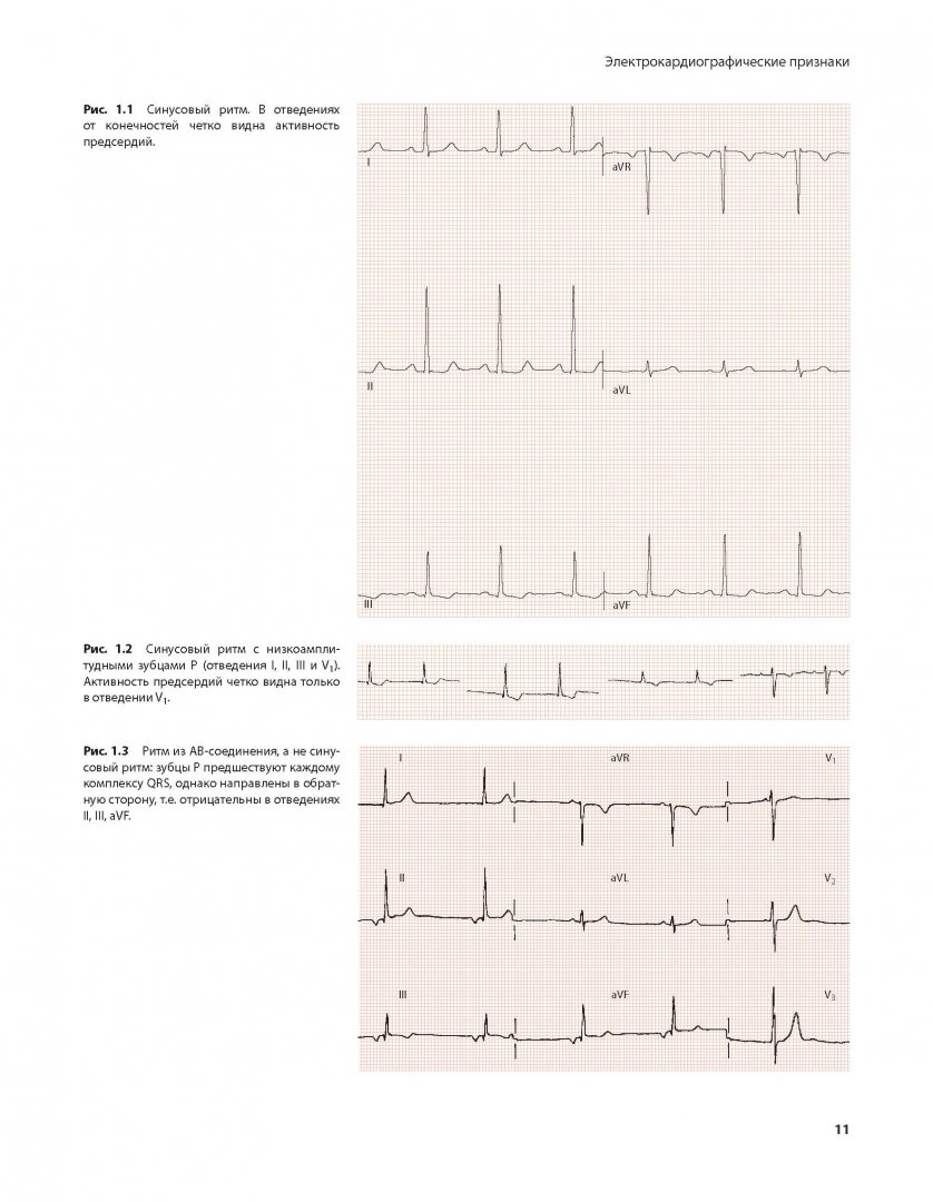 Иллюстрация 7 из 12 для Аритмии сердца. Практические заметки по интерпретации и лечению - Дэвид Беннет | Лабиринт - книги. Источник: Лабиринт