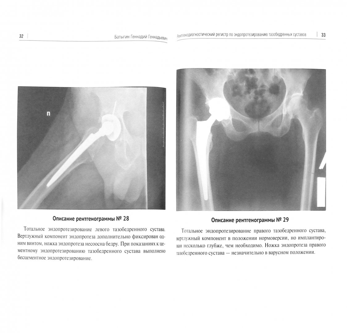 Иллюстрация 1 из 7 для Рентгенологический регистр по эндопротезированию тазобедренных суставов - Геннадий Батыгин | Лабиринт - книги. Источник: Лабиринт