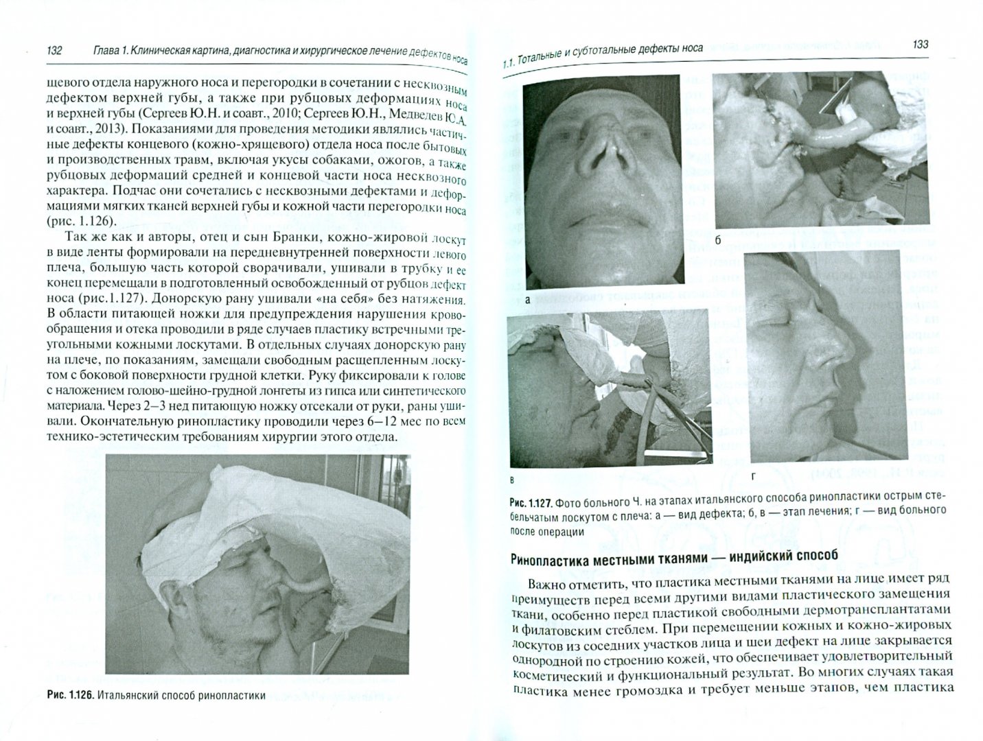 Иллюстрация 1 из 4 для Хирургическое лечение дефектов и деформаций носа - Эзрохин, Топольницкий, Сергеев | Лабиринт - книги. Источник: Лабиринт