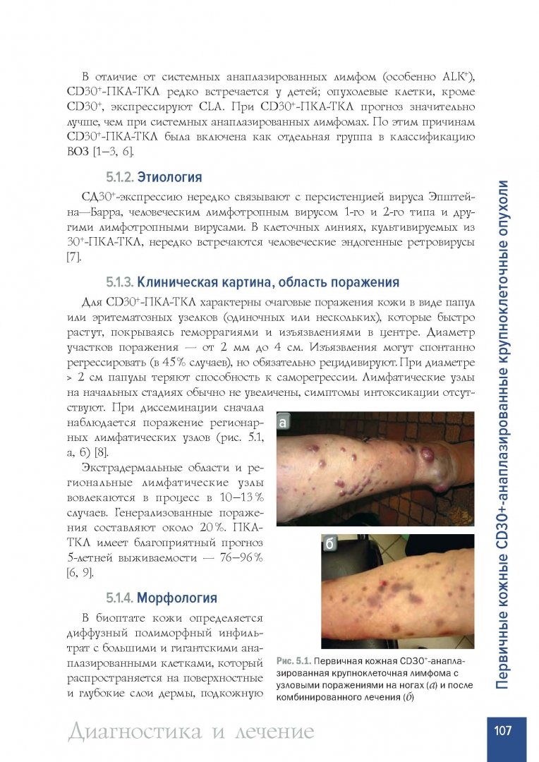 Иллюстрация 6 из 14 для Лимфомы кожи. Диагностика и лечение - Потекаев, Виноградова, Виноградов | Лабиринт - книги. Источник: Лабиринт
