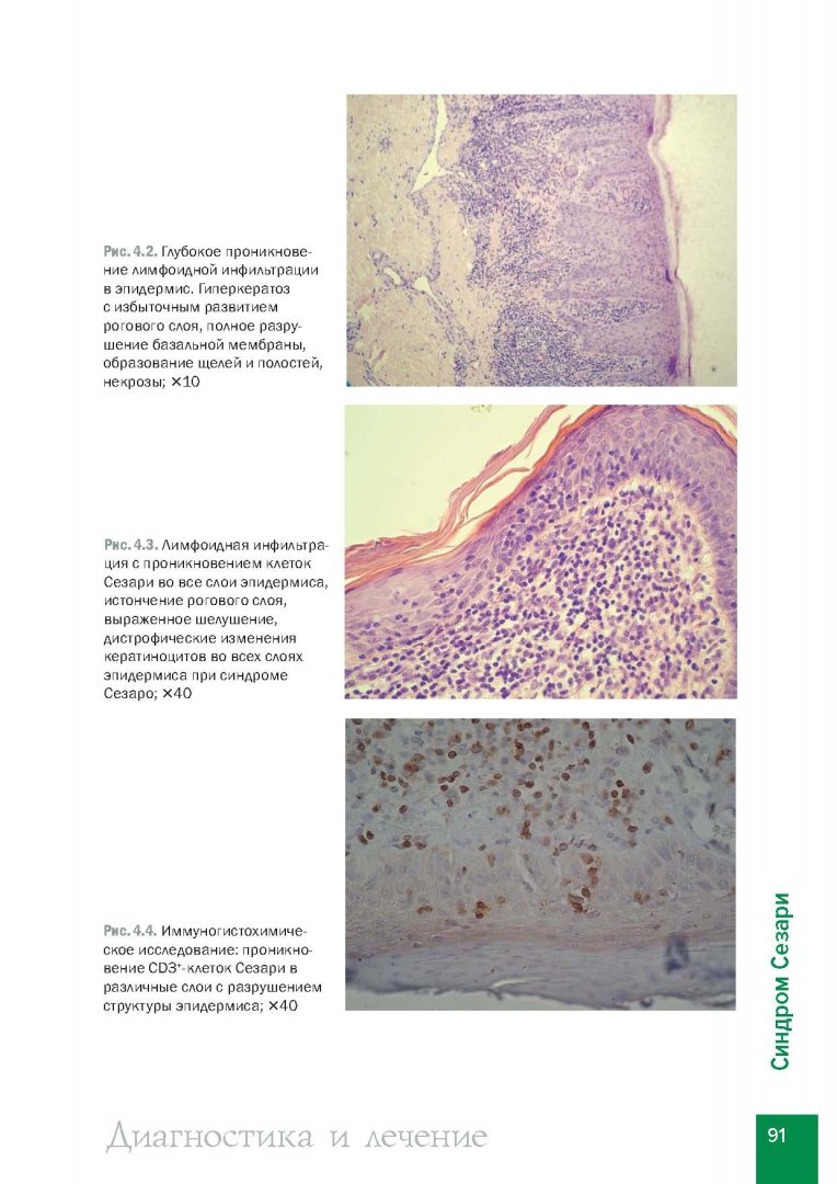 Иллюстрация 4 из 14 для Лимфомы кожи. Диагностика и лечение - Потекаев, Виноградова, Виноградов | Лабиринт - книги. Источник: Лабиринт