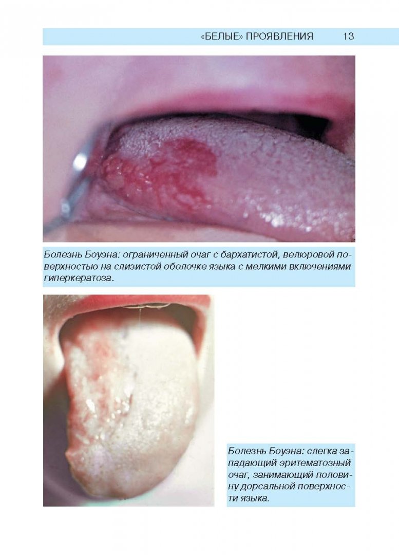 Иллюстрация 3 из 19 для Заболевания слизистой оболочки рта и губ - Арутюнов, Цветкова-Аксамит, Петрова | Лабиринт - книги. Источник: Лабиринт