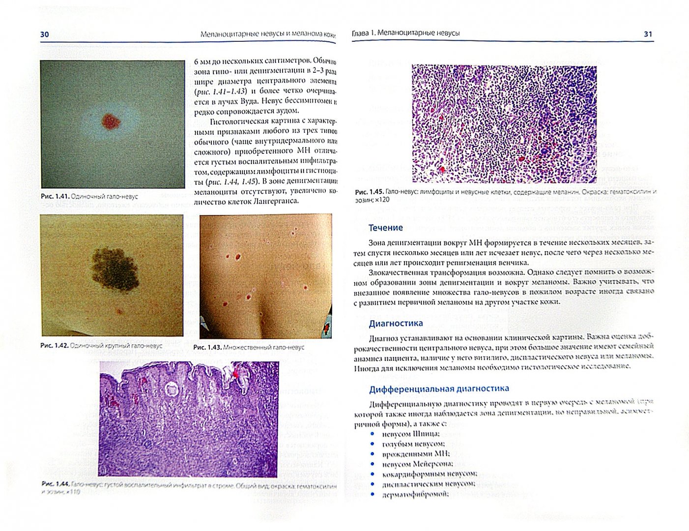 Иллюстрация 1 из 4 для Меланоцитарные невусы и меланома кожи. Руководство для практикующих врачей - Молочков, Демидов, Харкевич | Лабиринт - книги. Источник: Лабиринт