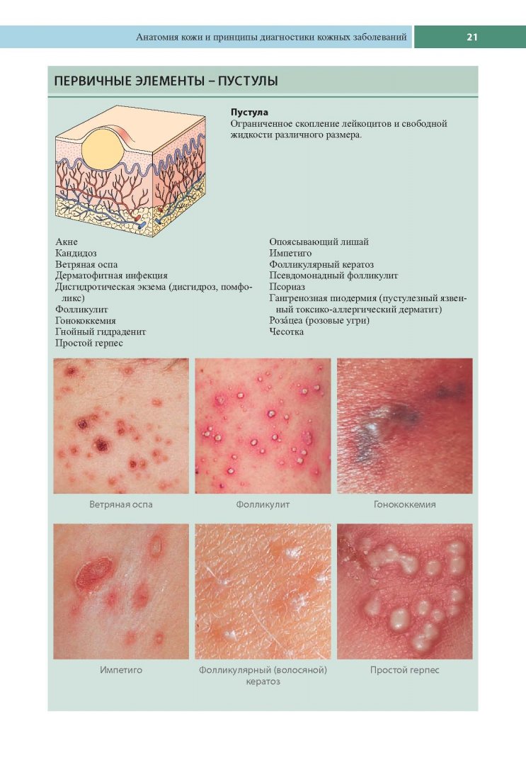 Иллюстрация 11 из 25 для Клиническая дерматология. Аллергические дерматозы - Томас Хэбиф | Лабиринт - книги. Источник: Лабиринт