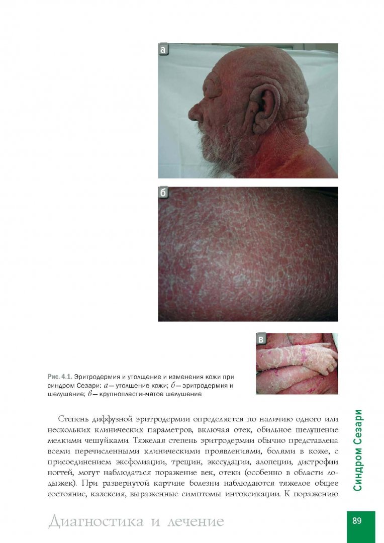 Иллюстрация 2 из 14 для Лимфомы кожи. Диагностика и лечение - Потекаев, Виноградова, Виноградов | Лабиринт - книги. Источник: Лабиринт