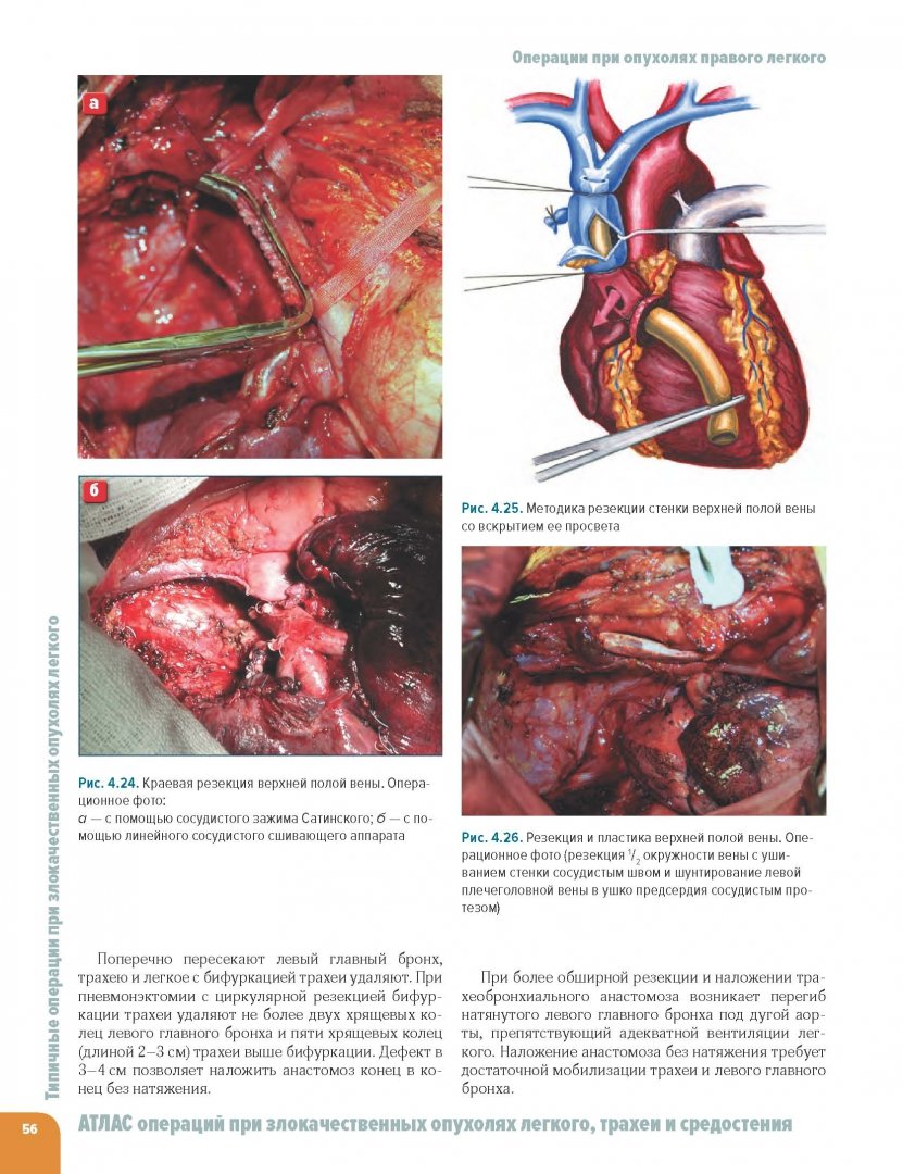 Иллюстрация 4 из 12 для Атлас операций при злокачественных опухолях легкого, трахеи и средостения - Трахтенберг, Колбанов, Пикин | Лабиринт - книги. Источник: Лабиринт